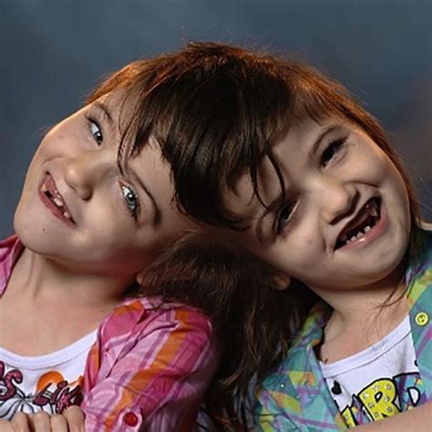 Где живут сиамские близнецы которые соединены мозгами в области таламуса — Музей фактов