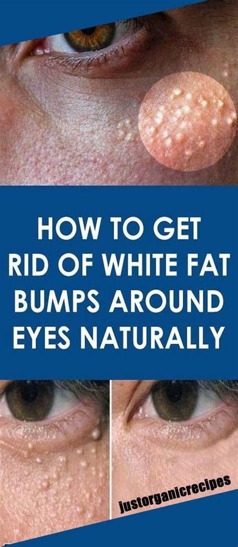 Do You Have White Bumps Around Your Eyes Remove Them With These 10