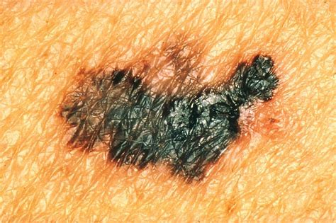 Melanoma Monday Melanoma Prevention 101 Online Dermatology