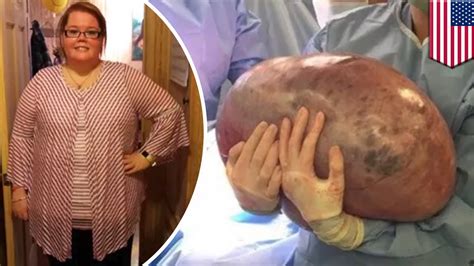 Giant 50 Pound Cyst Removed From Alabama Womans Ovary Tomonews Youtube