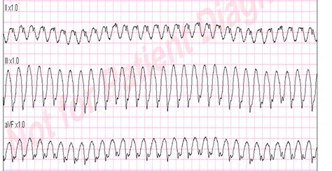 Dr Smiths Ecg Blog Very Fast Very Wide Complex Tachycardia