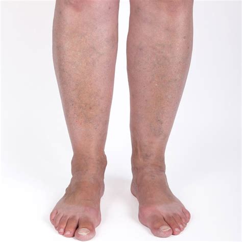 Varicose Veins Treatment And Removal The Cooden Medical Group