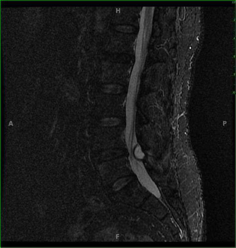 Lumbar Spine Synovial Cyst Neuro Mr Case Studies Ctisus Ct Scanning