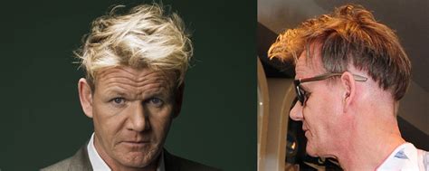 gordon ramsay and his hair transplants