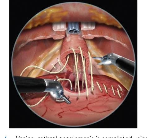 Figure 2 From Bidirectional Barbed Suture For Bladder Neck