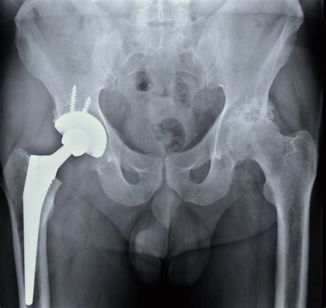 Hip Fracture Overview Causes Symptoms Treatment