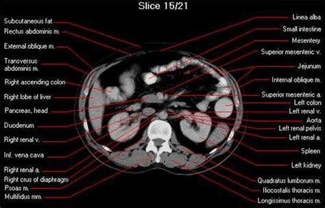 Axial Ct Whole Abdomen Scan Ct Scan Radiology Imaging Radiology