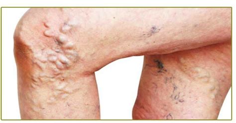 Why Humans Get Varicose Veins A Brief History