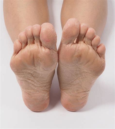 Dead Skin Under Feet Causes Symptoms And Treatment Artofit