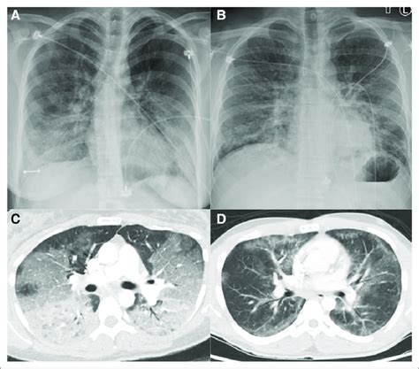 Chest Radiograph And Ct Angiogram Obtained From Two Patients With