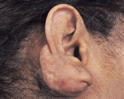Keloid Scarring After Ear Piercing Stock Image C0461711 Science