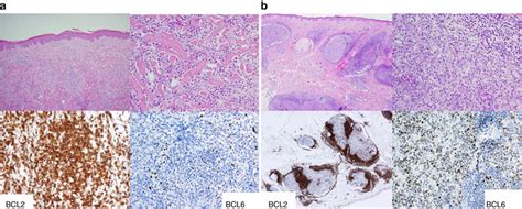 Histological Features Of Primary Cutaneous B Cell Lymphomas A
