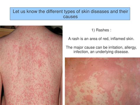 Ppt Different Types Of Skin Diseases And Their Causes