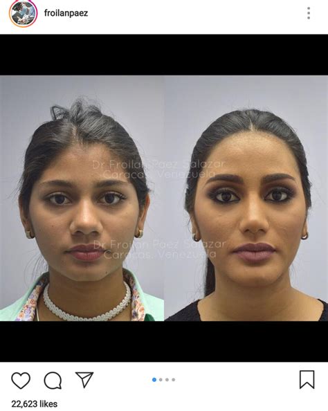 Before And After Photos Of Venezuelan Beauty Queens Circulate On Social