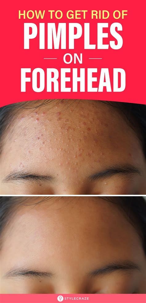 How To Get Rid Of Pimples On Forehead Pimples On Forehead Forehead