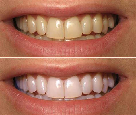 Do Teeth Whitening Strips Really Work Together Dental