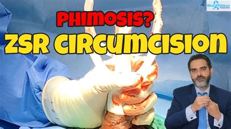 Phimosis Treatment Zsr Circumcision For Tight Foreskin Youtube
