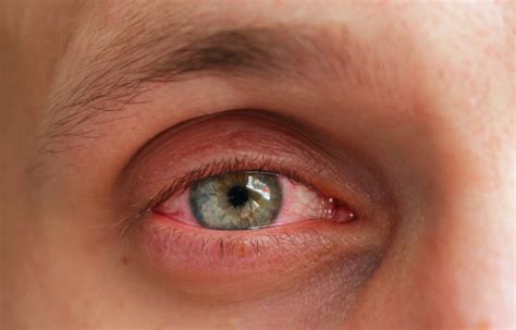 What Causes Eye Allergies And How Are They Treated
