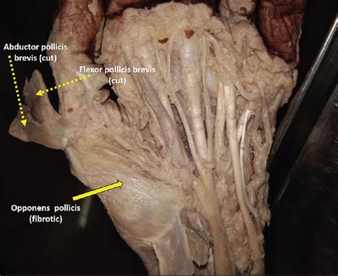 Flexor Pollicis Longus Cadaver