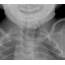Oesophageal Atresia With Tracheo Fistula 1  Dont Forget