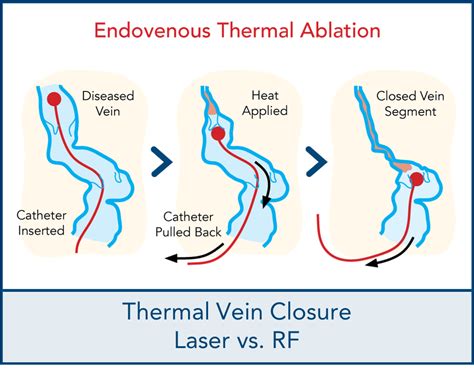 Rf Vs Laser Vein Ablation Similar Outcomes Dallas Vein Institute