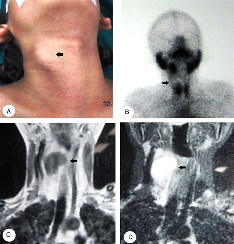 Unusual Diagnosis Of A Solitary Thyroid Nodule In The Paediatric