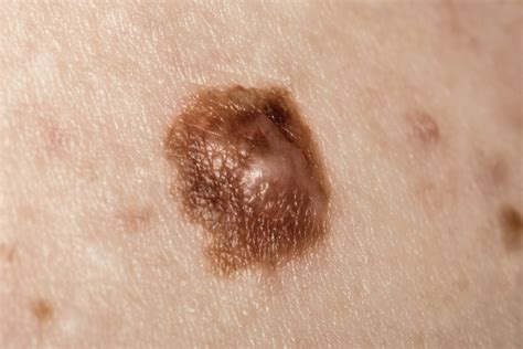 Melanoma Treatment Options At Each Stage