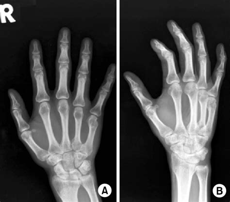 Figure 3 From Treatment Of 5th Metacarpal Neck Fracture Using