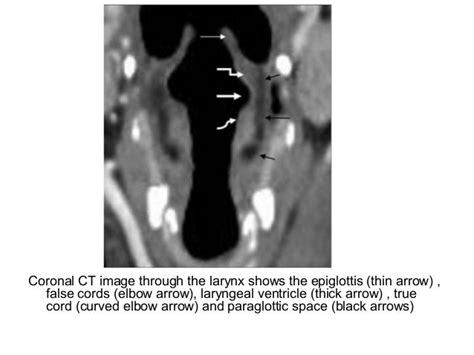 Larynx Anatomy Ct Scan Anatomy Structure