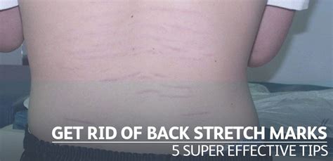 Get Rid Of Stretch Marks On Your Back 5 Super Effective Tips