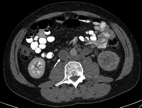 Inferior Vena Cava Thrombosis A Review Of Current Practice Bj Mcaree