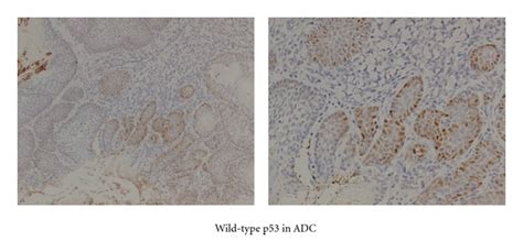 Immunohistochemical Staining For Wild Type P53 In Scc And Adc