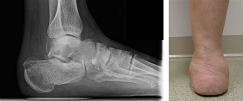 Calcaneus Fracture (Broken Heel Bone) | Orthopaedic Trauma ...