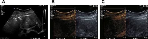 Ultrasound Of Renal Masses Radiologic Clinics