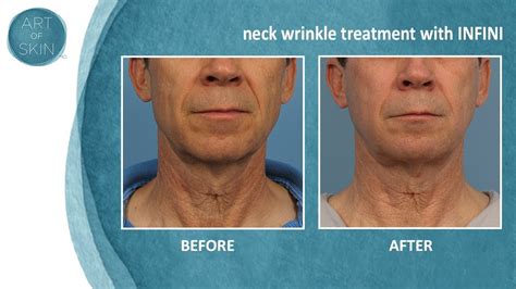 Neck Wrinkle Treatment With Radiofrequency Microneedling Youtube