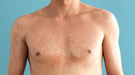 It is caused by an overgrowth of yeast on the skin. What Is Tinea Versicolor? Symptoms, Causes, Treatment, and ...