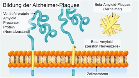 Alzheimer Eiweißablagerungen Im Gehirn Als Ursache