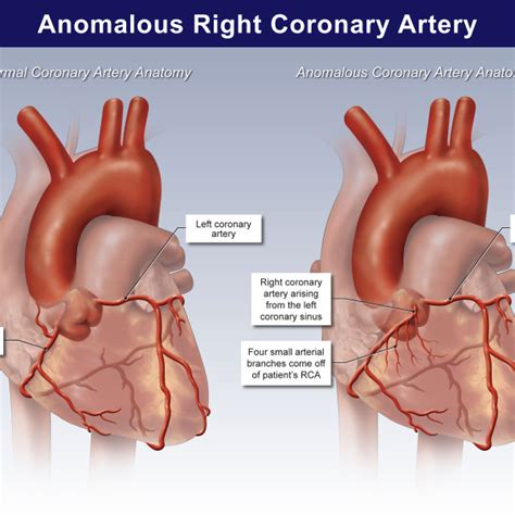 Anomalous Right Coronary Artery TrialExhibits Inc