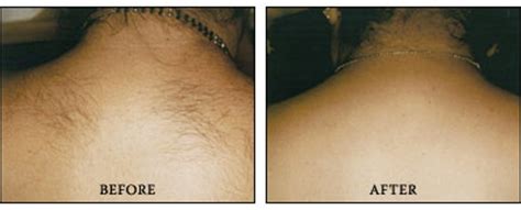 Hair removal cream with a suitable applicator. Permanent Laser Hair Removal & Reduction in Chicago ...