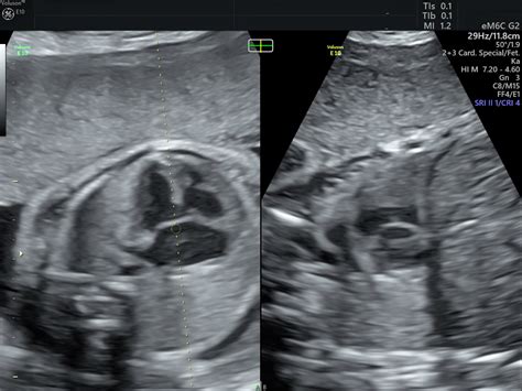 Fetal Heart Defects Ultrasound Empowered Women S Health