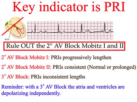 If the site of block is uncertain, an electrophysiological 3. 3rd Degree AV Block
