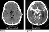Cerebro Medical Term Pictures