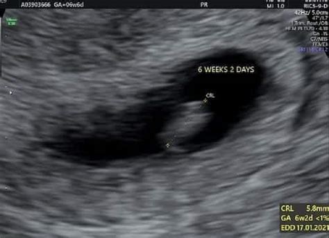 Twins Ultrasound Weeks