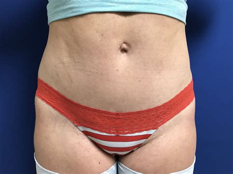 Abdominoplasty Before After Surgery Dr Zoran Potparic