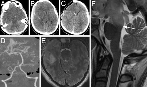 A B Axial Noncontrast Head Computed Tomography Ct Scan On