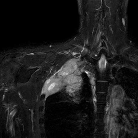 Brachial Plexus Tumor Philips Mr Body Map