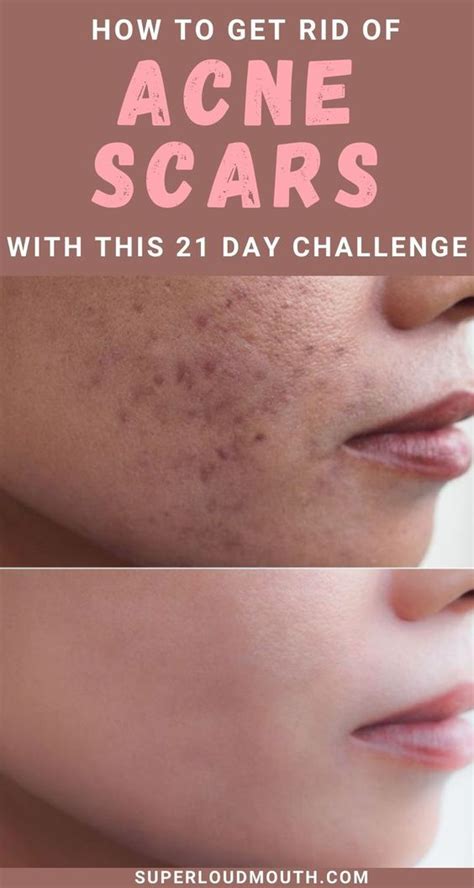 Heal Acne Scars Pimple Scars Clearing Acne Scars How To Cure Acne