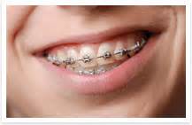 Whatever your needs, your team at aspen dental can help navigate which type of extraction is most appropriate for you, help you understand. How much do braces cost in Germany? - Quora