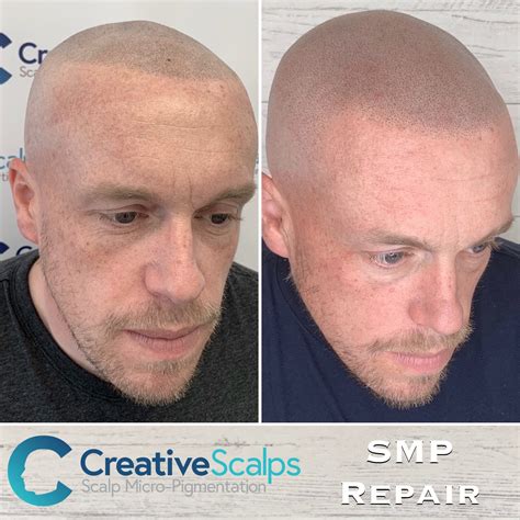 Scalp Micropigmentation before & after results | Best SMP ...