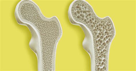 Osteoporosis causas síntomas y tratamiento